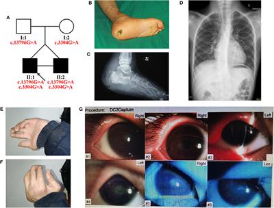 Novel Compound Heterozygous DST Variants Causing Hereditary Sensory and Autonomic Neuropathies VI in Twins of a Chinese Family